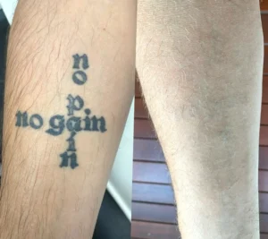 laser tattoo removal pain