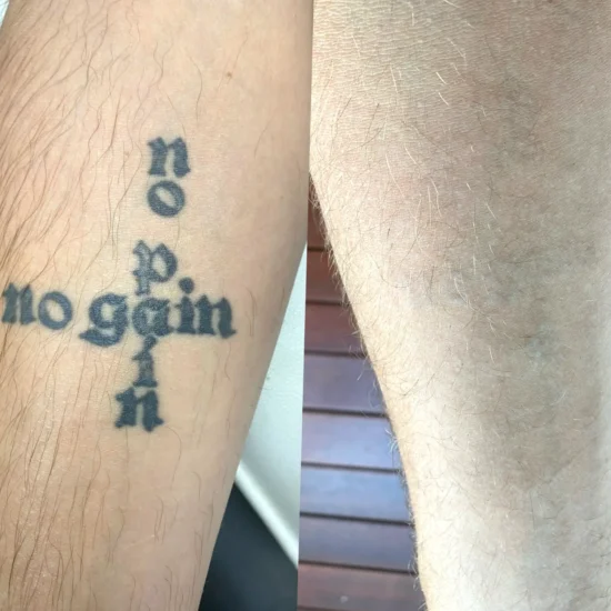 laser tattoo removal pain